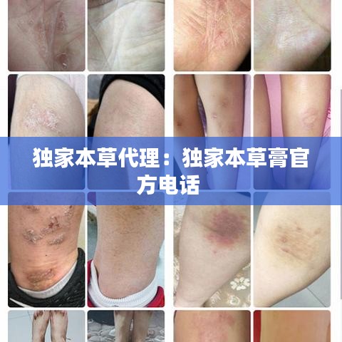 独家本草代理：独家本草膏官方电话 