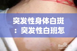 突发性身体白斑：突发性白班怎么治疗 